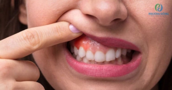 Tổng quan về viêm chân răng và cách chữa trị hiệu quả
