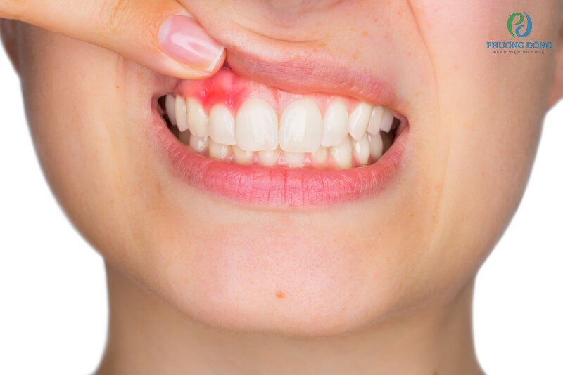 Viêm chân răng có thể dẫn tới mất răng