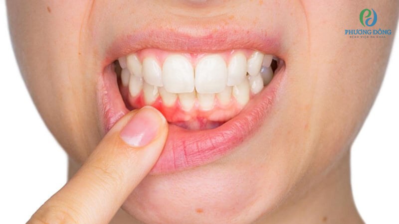 Nướu sưng đỏ, gây đau, có thể chảy máu khi đánh răng hoặc tự phát