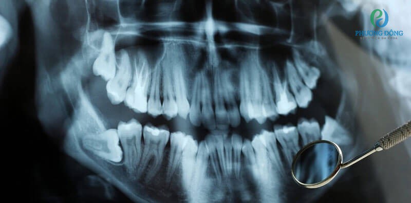 Chụp x-quang nha khoa để phát hiện tình trạng tiêu xương ổ răng