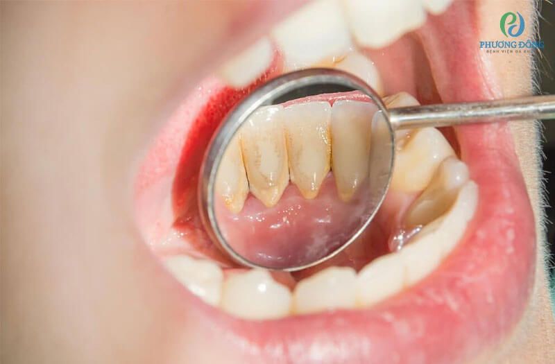 Lấy cao răng định kỳ và vệ sinh răng miệng kỹ càng để cải thiện bệnh