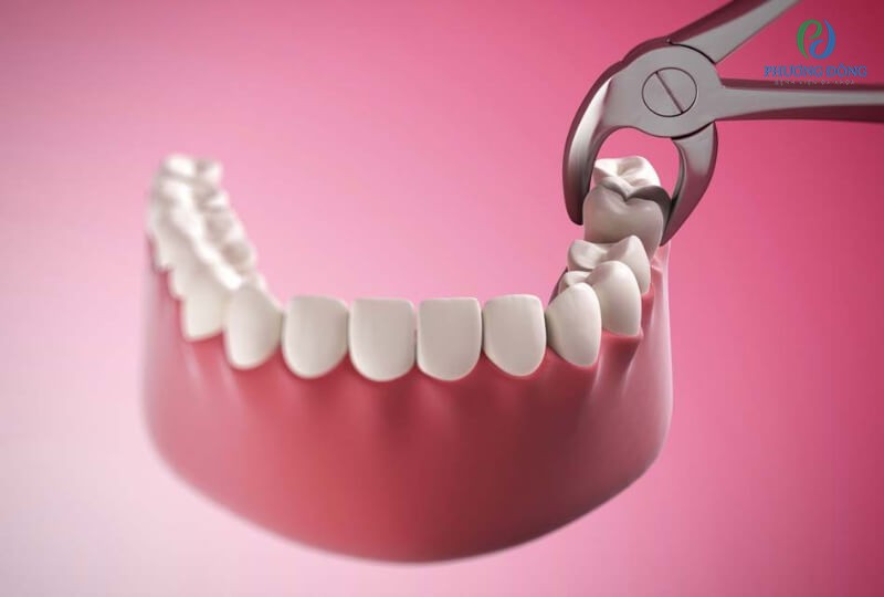 Nhổ răng bị hư hại nặng và trồng răng thay thế để đảm bảo chức năng ăn nhai