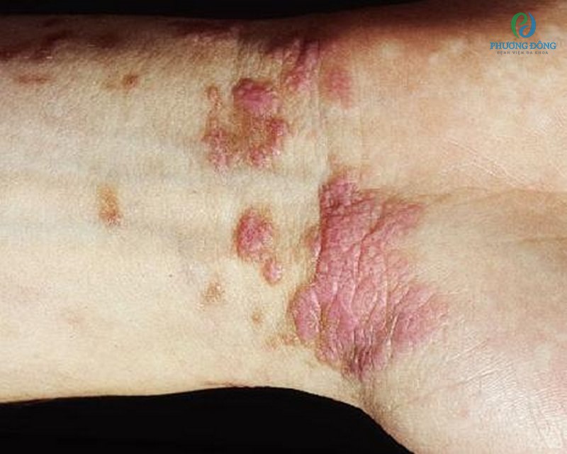 Những người mắc bệnh lý liên quan đến da có nguy cơ bị bệnh cao