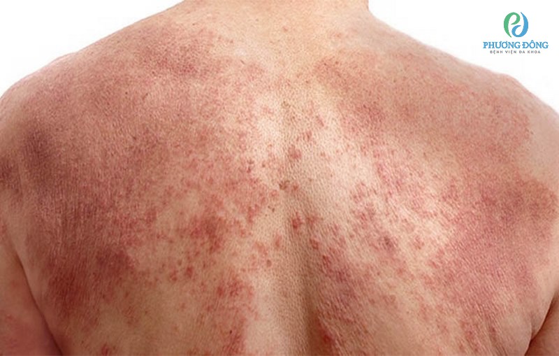 Bệnh thể hiện triệu chứng rõ rệt ở da và có thể nhìn thấy được