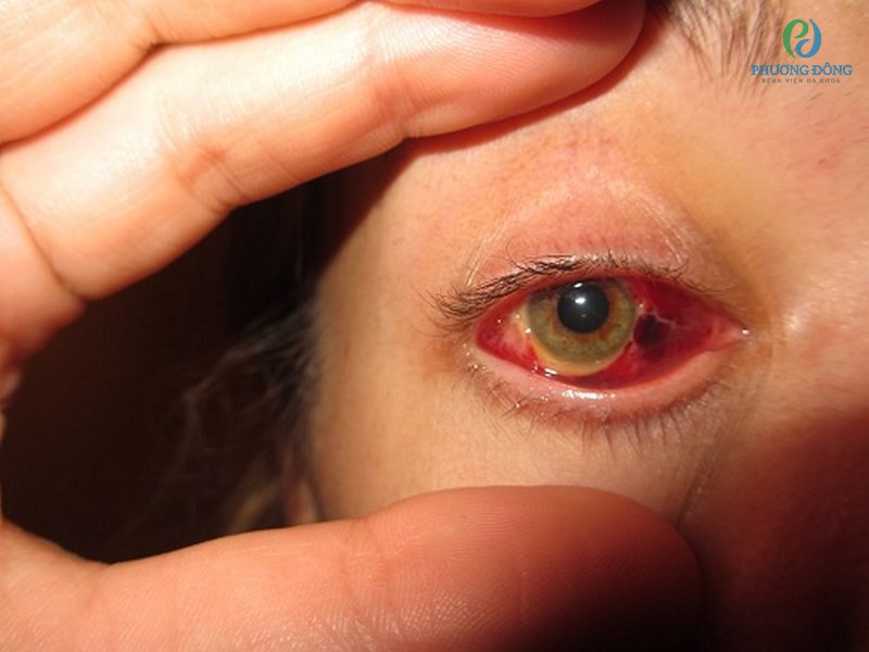 Xuất hiện lỗ hay vết rách ở lớp thần kinh cảm thị của mắt gây nên bệnh 