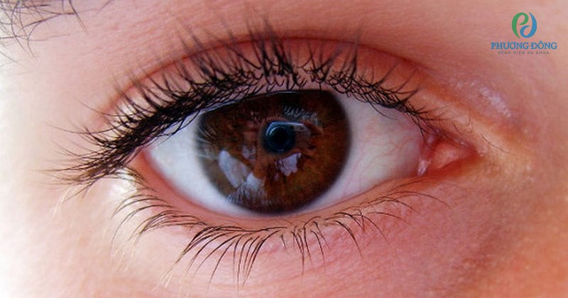 Bệnh bong và rách võng mạc không gây đau đớn gây rối loạn về thị giác