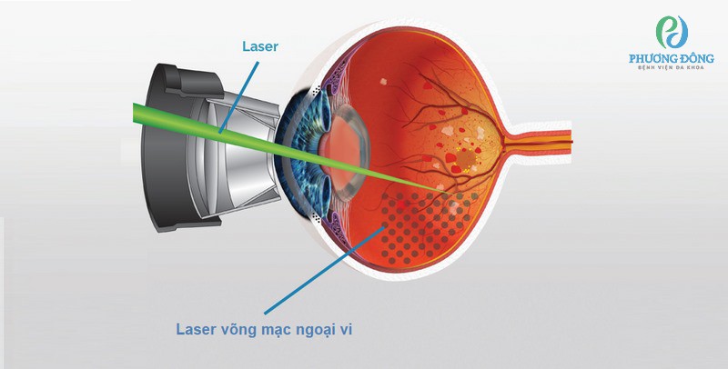 Phẫu thuật laser quang đông là phương pháp điều trị rách võng mạc an toàn