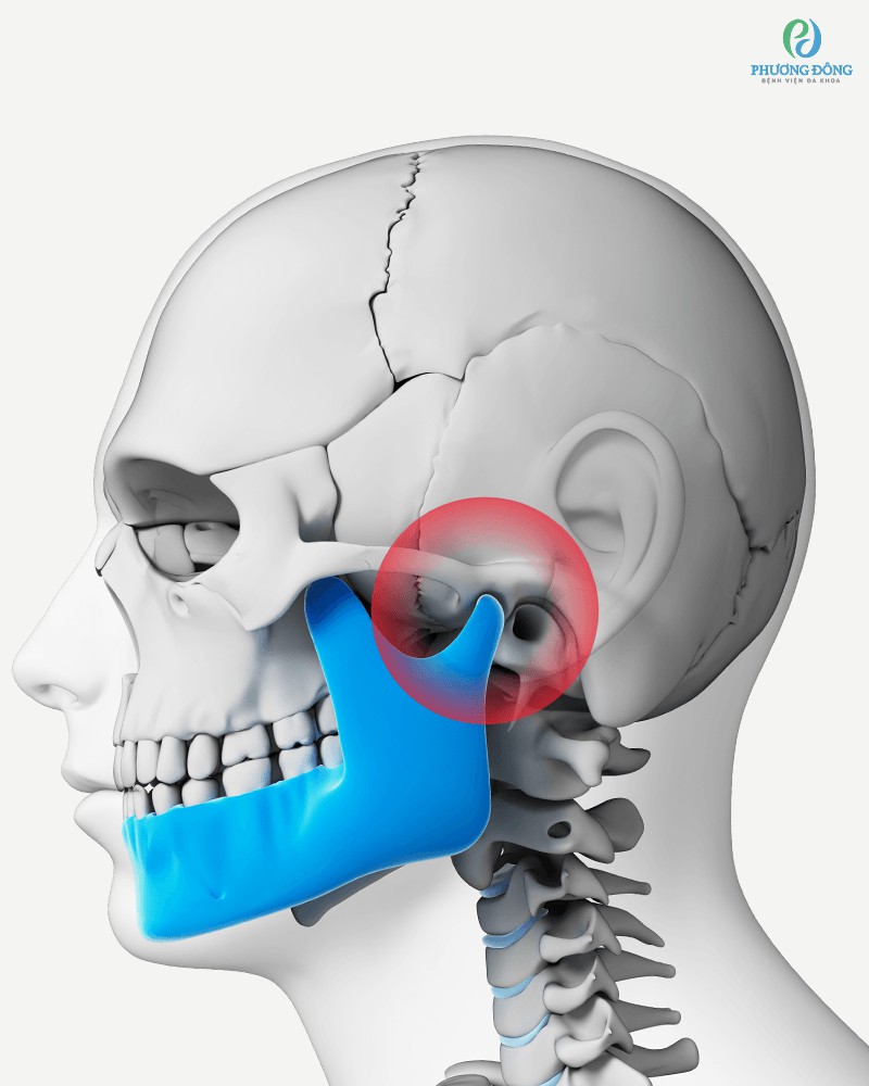 Viêm khớp thái dương hàm dẫn tới đau nhức và khớp phát ra tiếng lộp cộp khi cử động hàm