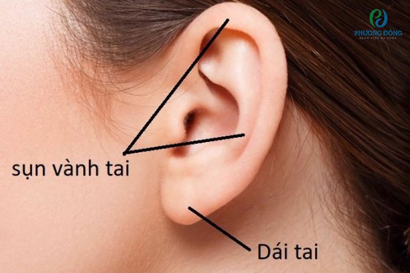 Người bệnh cần vệ sinh tai sạch sẽ và bảo vệ tai trong các hoạt động