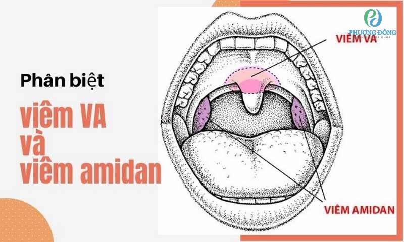 Amidan và VA có vị trí khác nhau trong họng không? 
