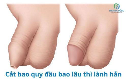 Cắt bao quy đầu bao lâu thì lành hẳn & Khi nào phải cắt bao quy đầu