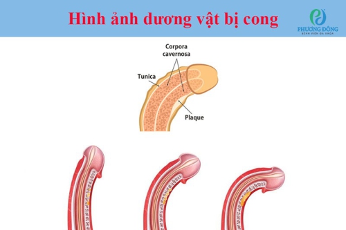 Cong dương vật: Nguyên nhân, chẩn đoán và cách phòng ngừa