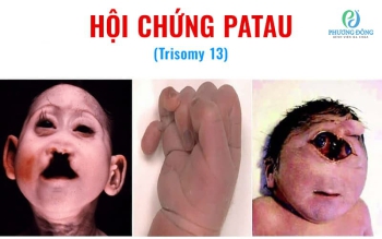 Hội chứng Patau: Nguyên nhân, triệu chứng và cách điều trị