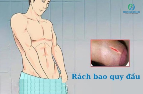 Rách bao quy đầu: Nguyên nhân, dấu hiệu và cách xử lý