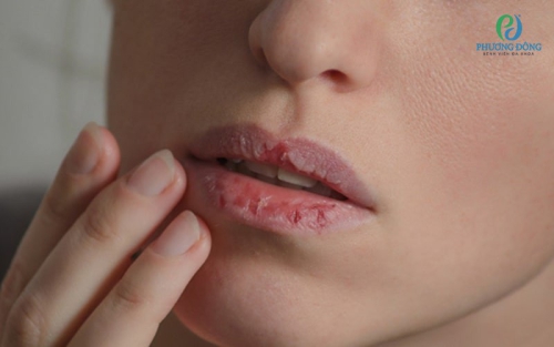 Viêm môi dị ứng – Nguyên nhân, dấu hiệu, cách chữa trị