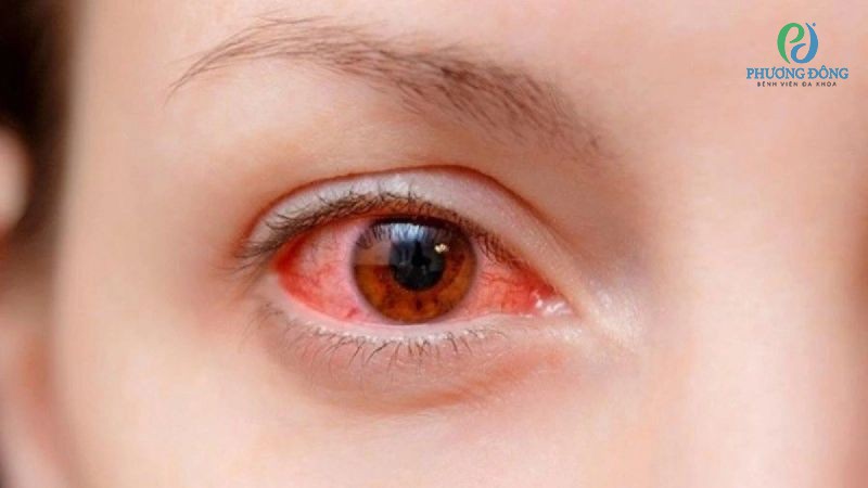 Đau mắt đỏ do vi khuẩn Chlamydia trachomatis xâm nhập và gây nên