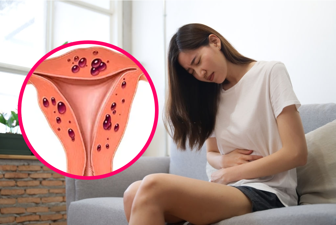 Lạc nội mạc tử cung gây đau vùng bụng dưới ở nữ giới.