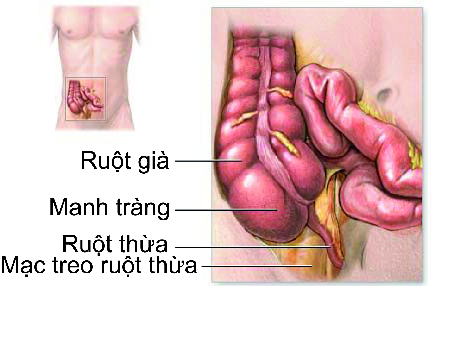 Viêm ruột thừa có thể gây đau vùng bụng dưới dữ dội.