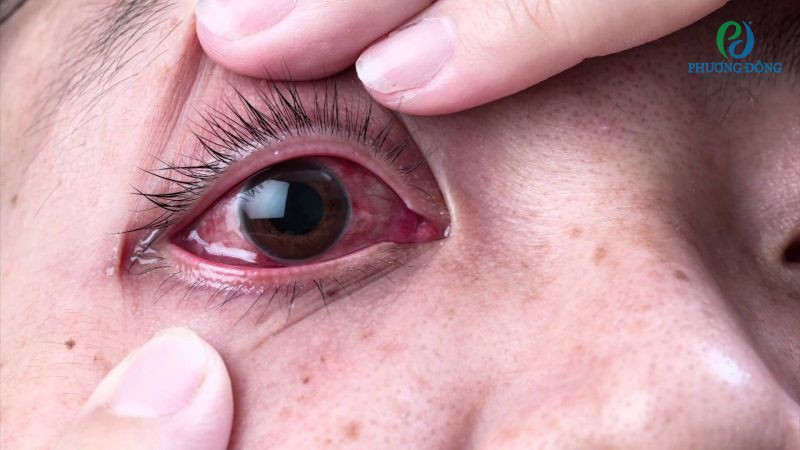 Bệnh đau mắt hột để lại hậu quả nguy hại đối với bệnh nhân