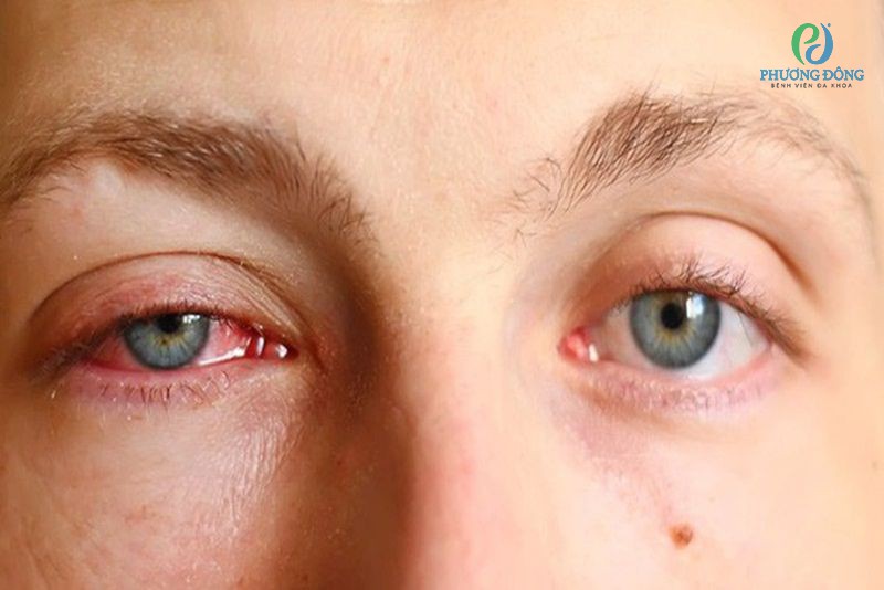 Bệnh thường bắt đầu ở 1 mắt, sau đó lây sang mắt còn lại