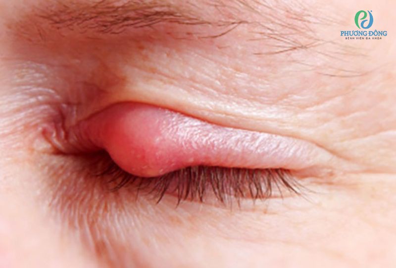 Bệnh đau mắt hột thường lâu khỏi, dễ tái nhiễm với những biến chứng nặng