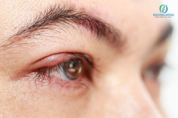 Đau mắt hột và đau mắt đỏ có gì giống và khác nhau?
