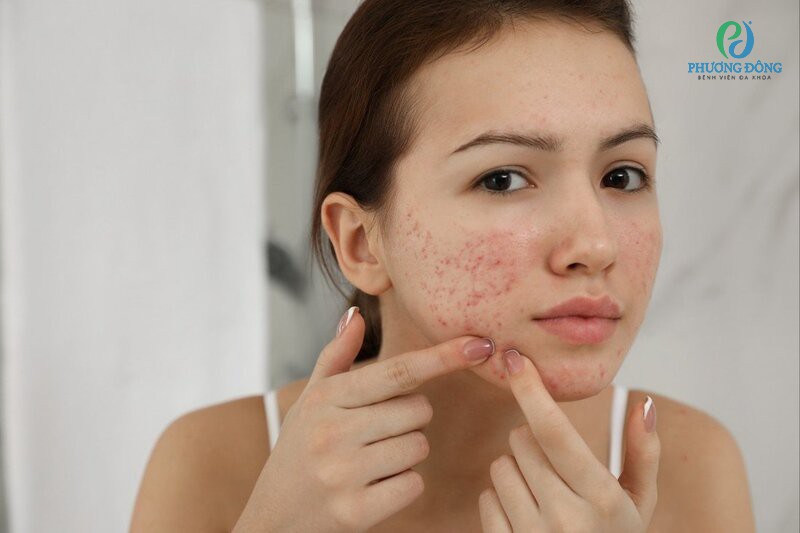 Dấu hiệu điển hình của da mặt dị ứng là nổi mẩn đỏ