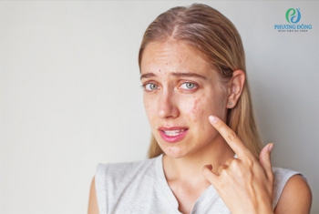 Nguyên nhân, dấu hiệu và cách xử lý khi dị ứng da mặt