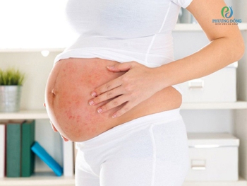 Dị ứng thai kỳ có những biểu hiện nào? Phải làm sao khi dị ứng thai kỳ?