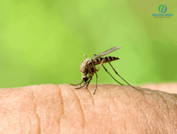 Top 15 cách điều trị bệnh sốt rét tại nhà cần biết