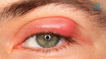 Tìm hiểu con đường lây của bệnh đau mắt hột