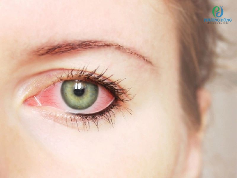 Đau mắt hột là căn bệnh nghiêm trọng do vi khuẩn Chlamydia trachomatis lây nhiễm 