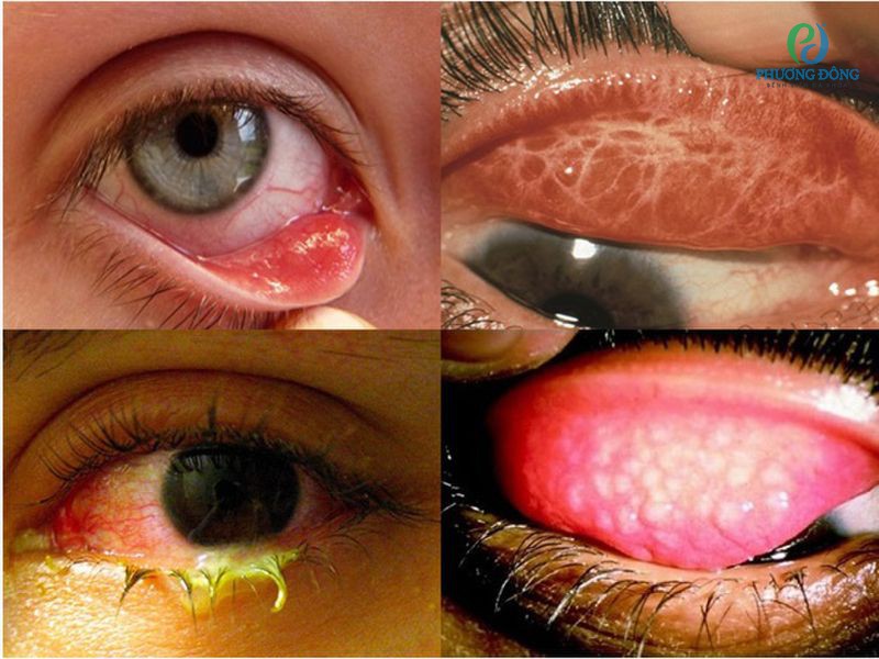 Bệnh đau mắt hột do vi khuẩn gây nên diễn tiến rất nhanh