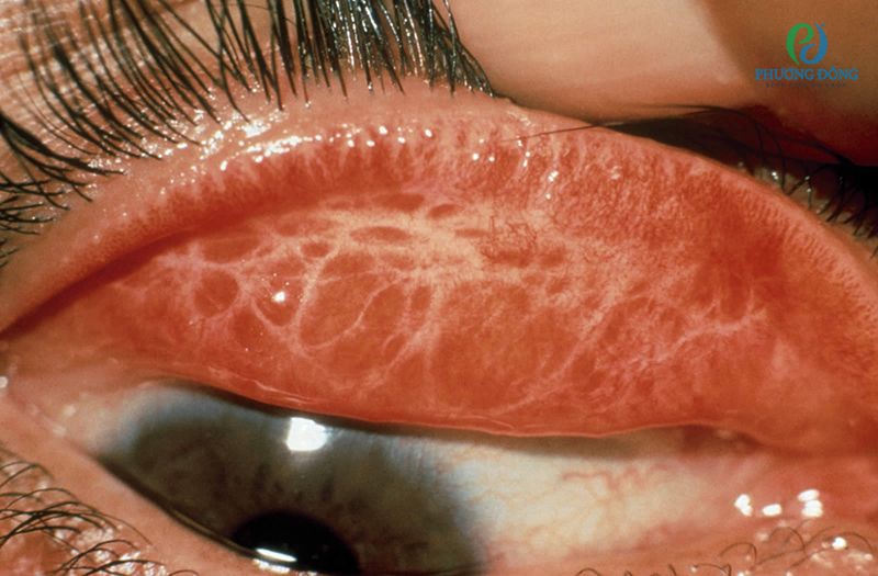 Tình trạng sẹo hóa mí mắt với các vạch trắng có thể nhìn thấy được ngay khi lật mí mắt lên