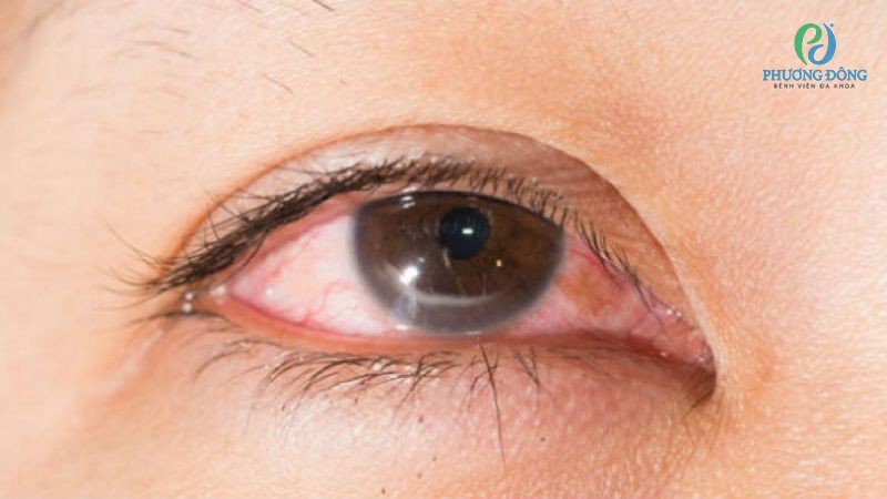Tình trạng viêm kéo dài, liên tục khiến giác mạc bị viêm và ảnh hưởng xấu đến thị lực