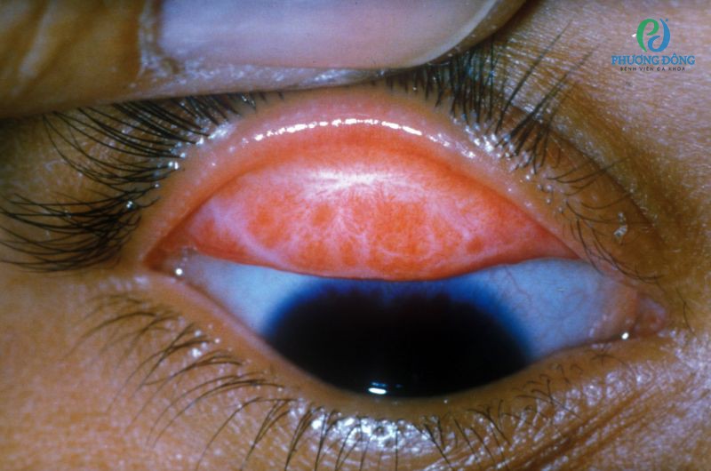 Dải sẹo hình sao trên mắt bệnh nhân đau mắt hột giai đoạn nặng