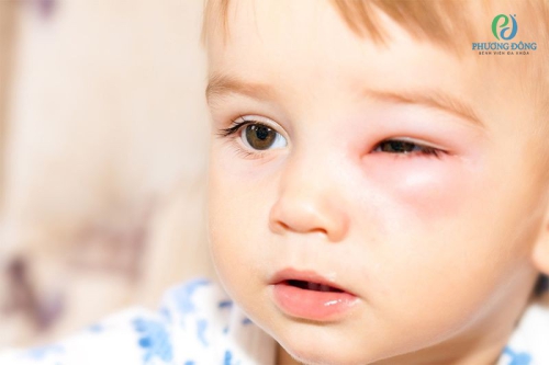 Trẻ bị đau mắt hột: Nguyên nhân, dấu hiệu, biến chứng và điều trị