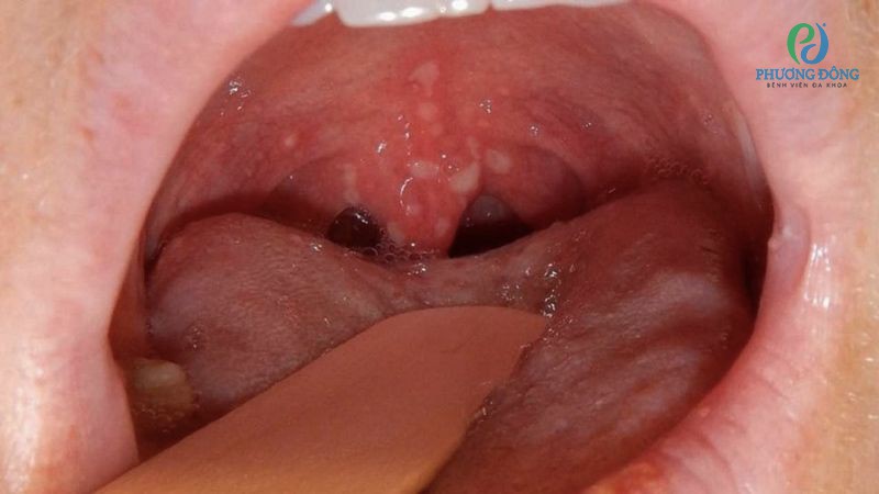 Chẩn đoán bệnh u xơ vòm mũi họng thường dựa theo khám lâm sàng