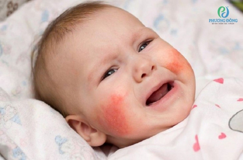 Viêm da dị ứng ở trẻ em: Nguyên nhân, điều trị và cách phòng ngừa