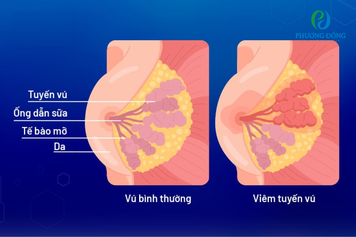 Viêm tuyến vú là tình trạng mô tuyến vú bị viêm, biểu hiện qua sự sưng to và đau