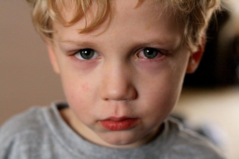 Trẻ em thiếu vitamin A thường thấp, mắt mờ
