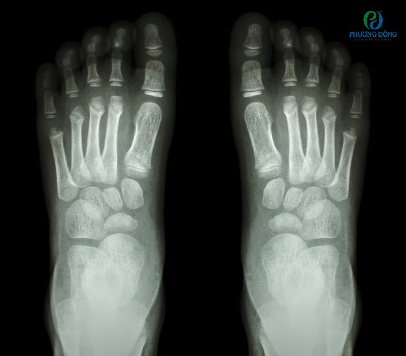 Phim chụp X quang bàn chân