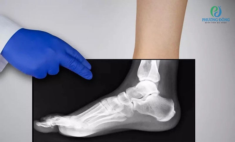 Quy trình chụp X quang bàn chân đơn giản và dễ dàng