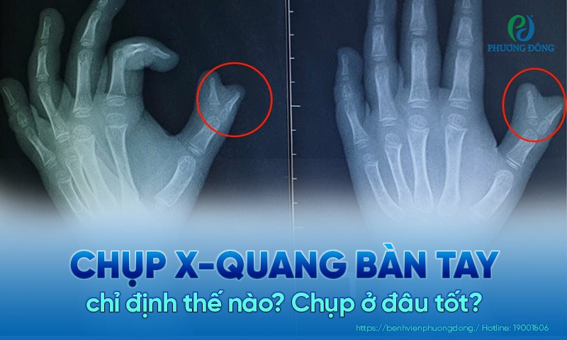 Chụp  x-quang bàn tay là kỹ thuật chẩn đoán hình ảnh phổ biến 