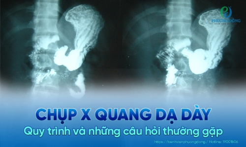 Chụp X quang dạ dày: Những thông tin quan trọng cần biết