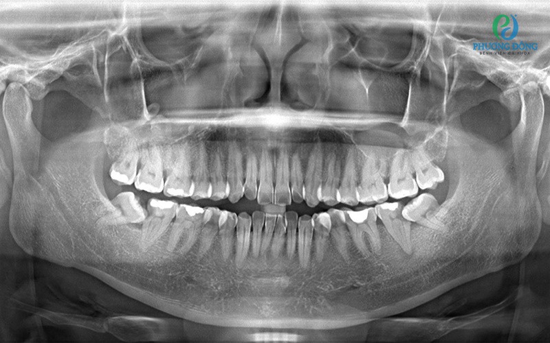Sử dụng hình ảnh từ chụp X-quang răng khôn giúp bác sĩ nha khoa đưa ra chẩn đoán chính xác và lên kế hoạch điều trị hiệu quả hơn