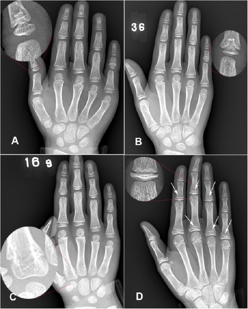 Chụp x quang xương bàn tay ở các vị trí khác nhau sẽ cho thấy kết quả chính xác nhất.