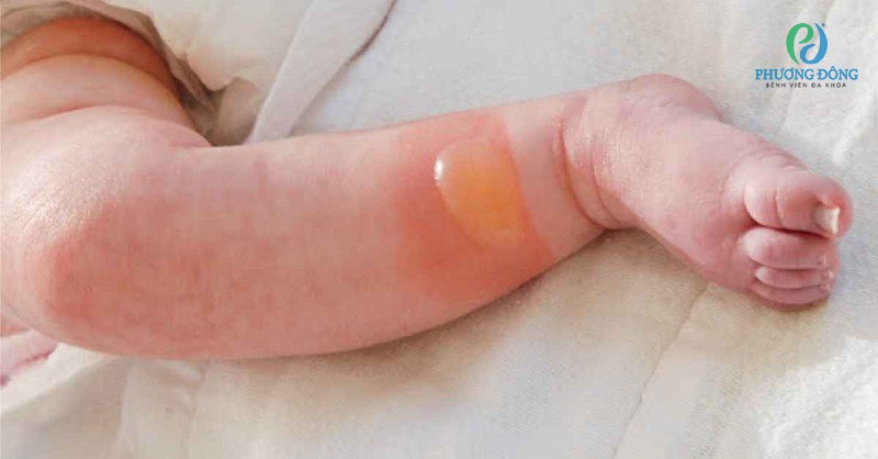 Hình ảnh bệnh ly thượng bì bóng nước trẻ sơ sinh
