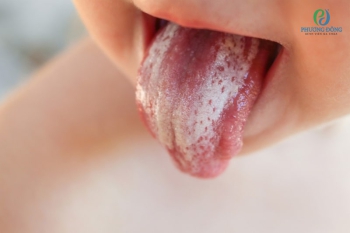 Nấm miệng – Nguyên nhân, triệu chứng, phương pháp điều trị