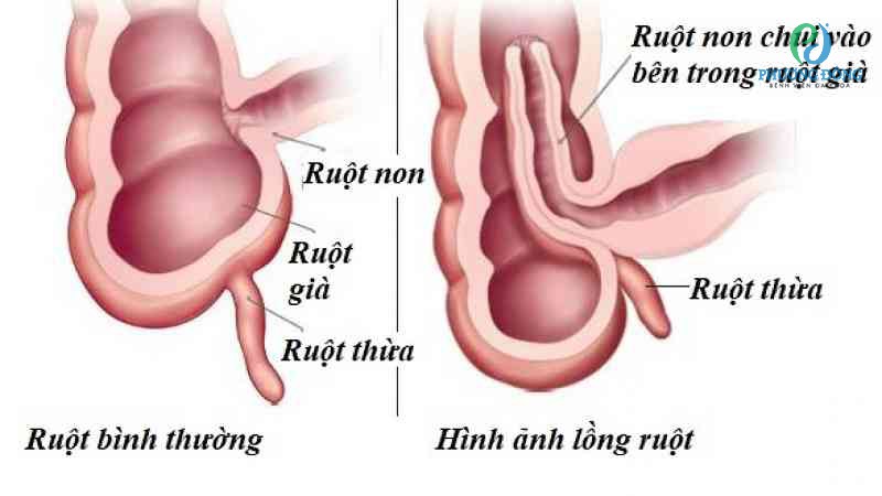Hình ảnh đoạn ruột dưới bị lồng ruột ở trẻ nhỏ